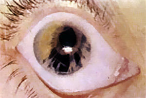 Eye Conditions and Diseases
